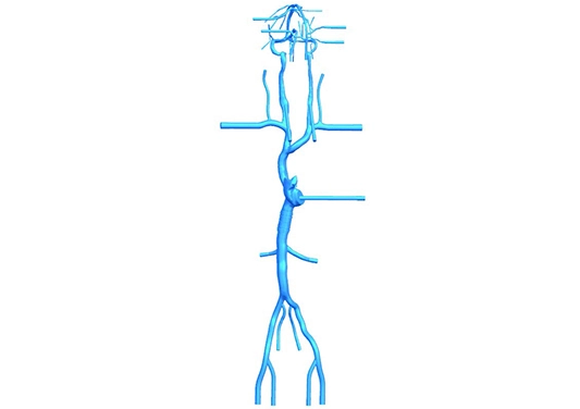 Drawing of Intracranial Femoral Vein Model