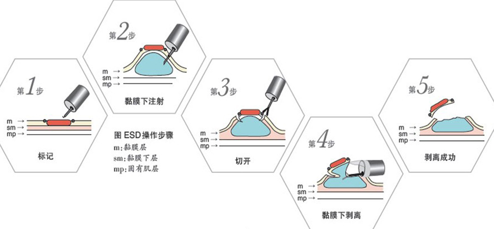 胃镜ESD手术操作示意图.png