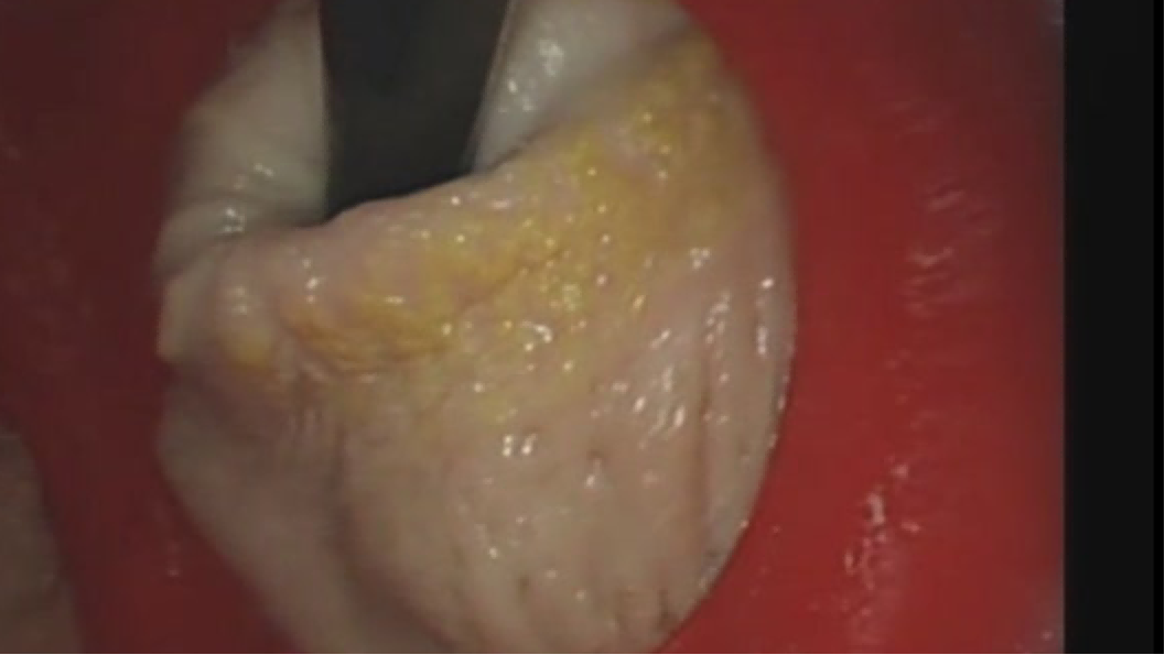 璞临胃镜ESD手术训练模型手术训练过程图像.png 璞临胃镜ESD手术训练模型手术训练过程图像.png