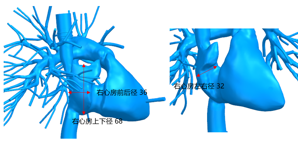 璞临医疗右心-肺动脉模型产品细节图.png