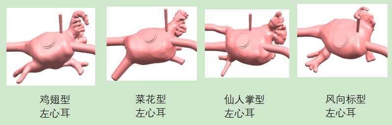 四种左心耳模块.png 四种左心耳模块.png